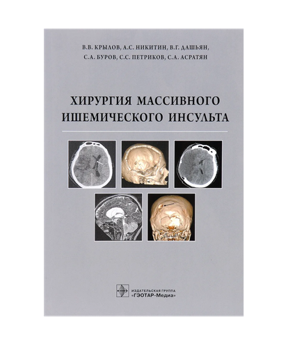 Хирургия массивного ишемического инсульта | Крылов